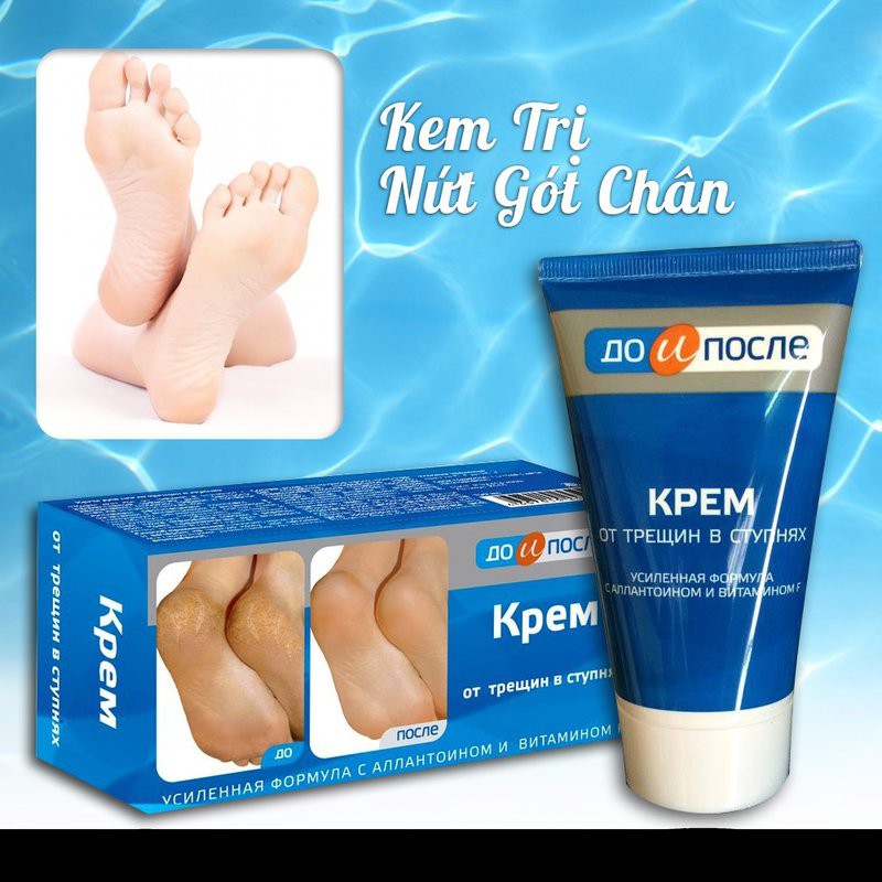 Kem Kpem Nga Trị Nứt, Nẻ Gót Chân Dưỡng Thể-1