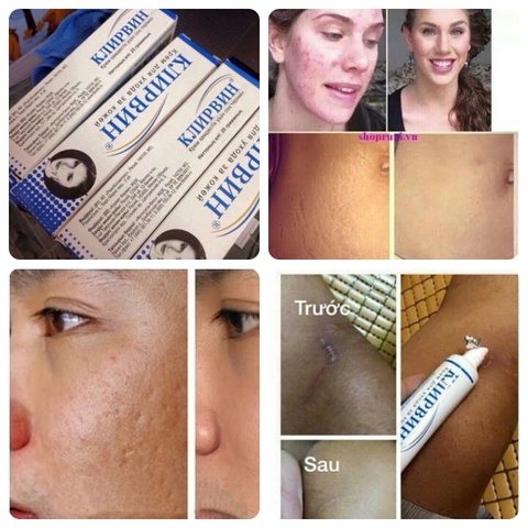 Kem Trị Sẹo Thâm Klirvin Nga Trang Điểm Khuôn Mặt-1