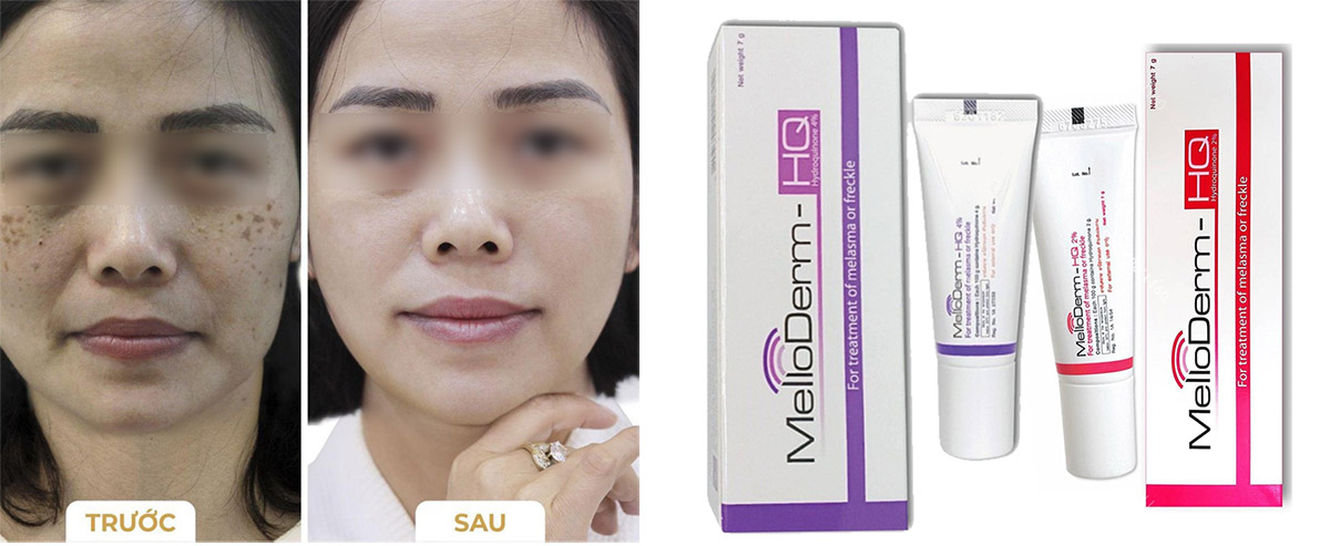 Thuốc Trị Nám Tàn Nhang Đồi Mồi MelloDerm Thái Lan Chăm Sóc Mặt-1