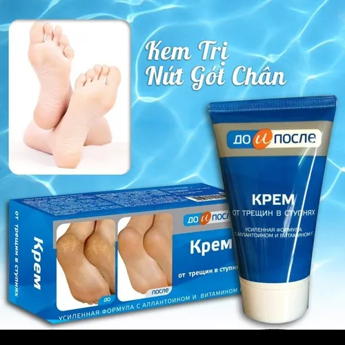 Kem Kpem Nga Trị Nứt, Nẻ Gót Chân